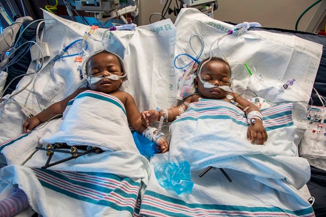In this November 8, 2016 photo provided by the Le Bonheur Children’s Hospital, twins from Nigeria, Miracle and Testimony Ayeni, rest after being separated at Le Bonheur Children's Hospital in Memphis, Tenn. The girls were conjoined at the lower half of the body and separated following about an 18-hour procedure. (Lisa W. Buser/Le Bonheur Children’s Hospital via AP)