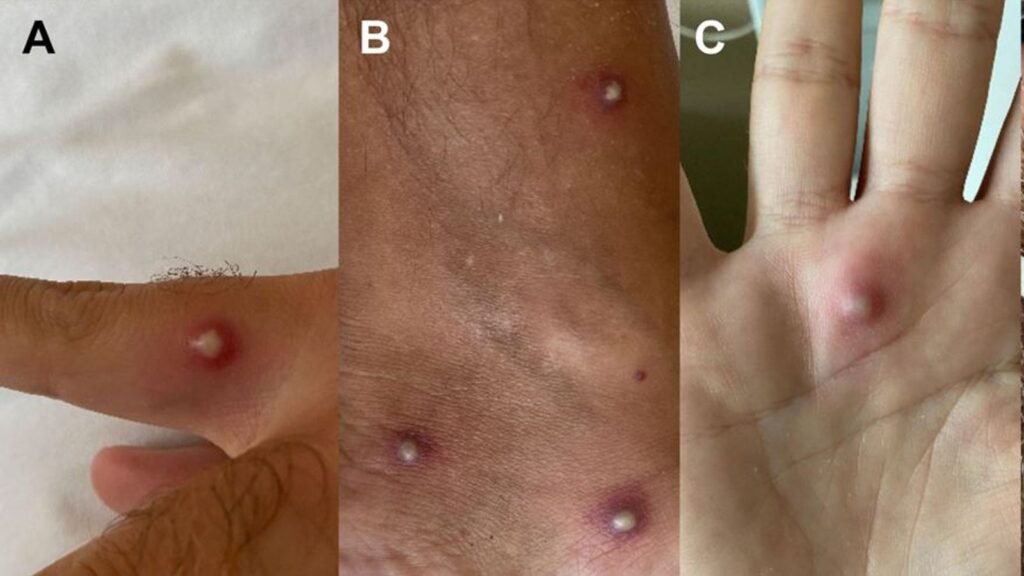 Man tests positive for monkeypox, COVID and HIV after holiday to Spain A 36-year-old patient in Italy returned from holiday in Spain and later presented with a series of symptoms that led doctors to carry out a series of tests. They found he was the first patient so far discovered to have COVID, monkeypox and HIV. Philip Whiteside News reporter Thursday 25 August 2022 13:36, UK Large spots on the body of a man who was found to be suffering from monkeypox. Pic: Journal of Infection Image: Large spots on the body of a man who was found to be suffering from monkeypox