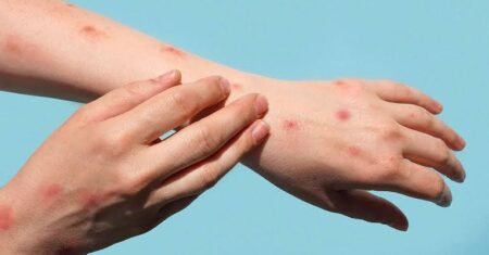 Thailand confirms Asia’s first case of deadly mpox strain