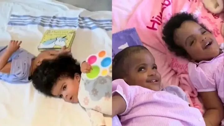 Ethiopian conjoined twins after separation surgery